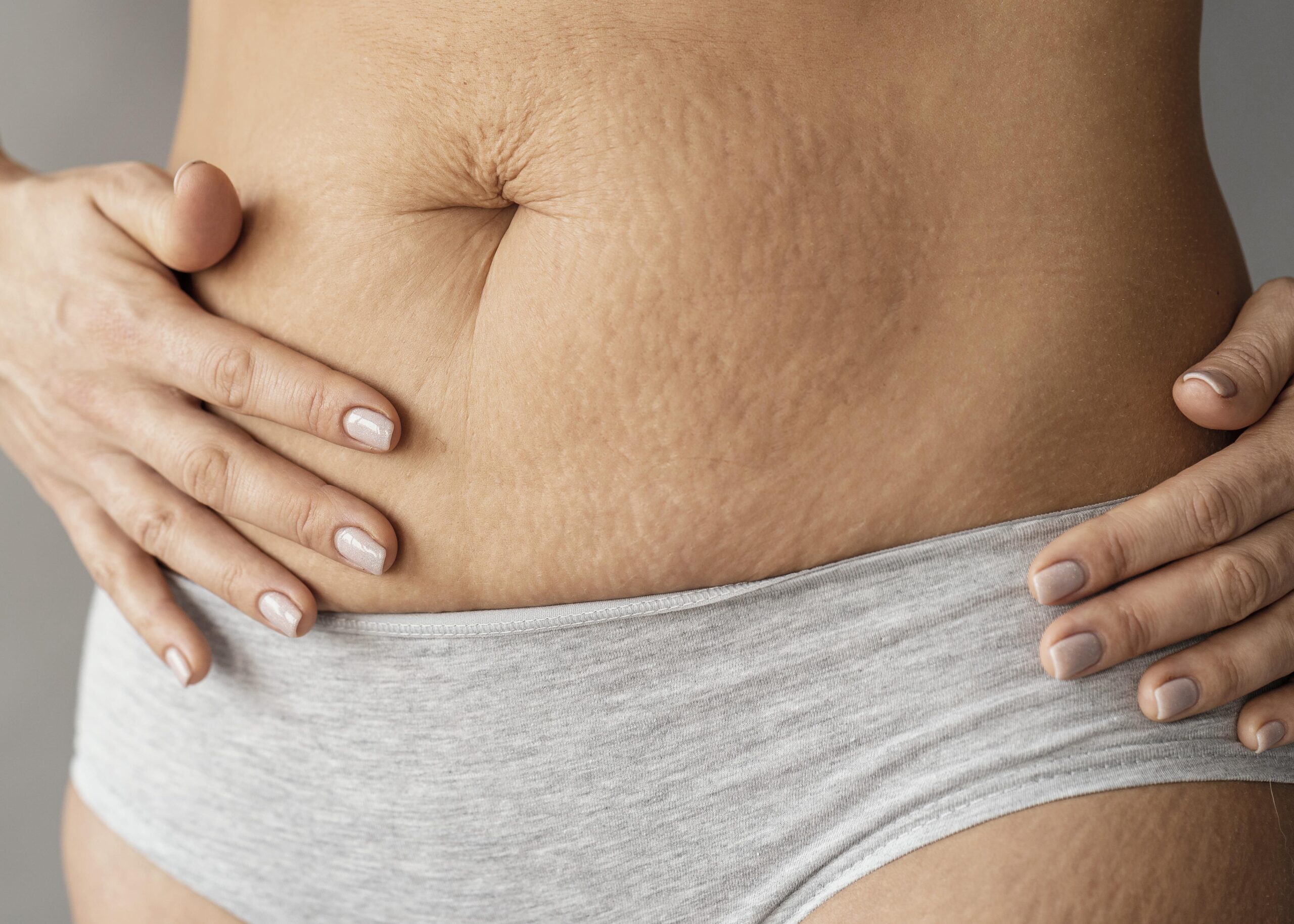 close-up-woman-with-stretch-marks